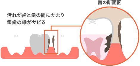 銀歯が錆びて虫歯に至る図