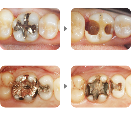 主に銀歯治療後５～７年後に痛みが再発し、再治療を行う流れを３～４回繰り返すと、歯がなくなってしまう
